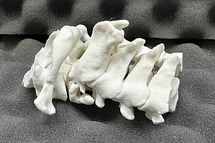 В Кирове нейрохирурги помогли мужчине с редким повреждением позвоночника